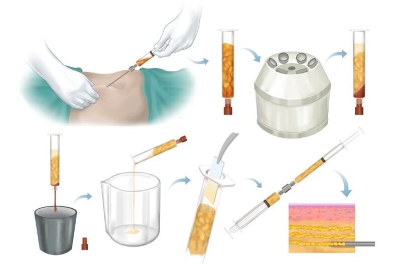 Arazoetako guneetatik gantzak kentzea, prozesatzea eta bularreko ehunean injektatzea