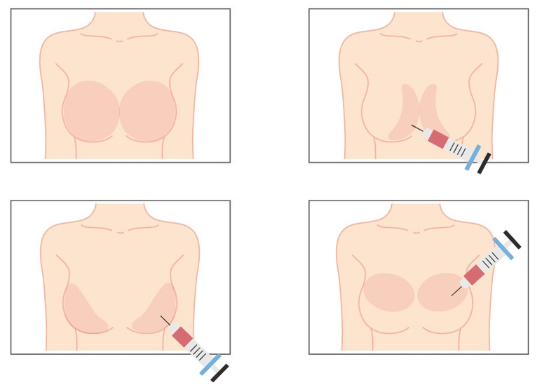 Azido hialuronikoa bularrean injektatzeko lekuak